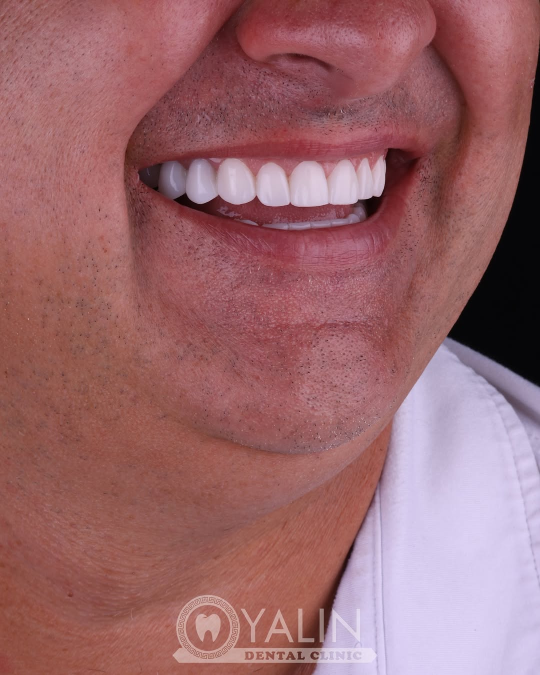 turkey-teeth-veneers before and after-2 