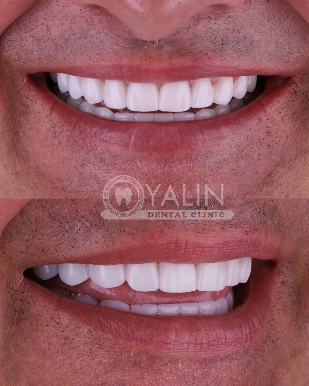 turkey-teeth-veneers before and after-3 