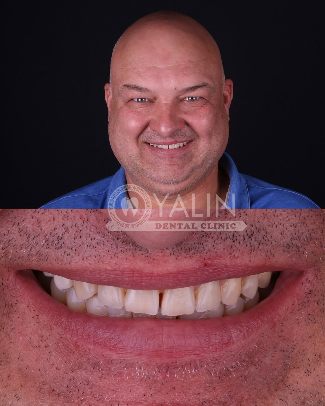turkey-teeth-veneers before and after-4 