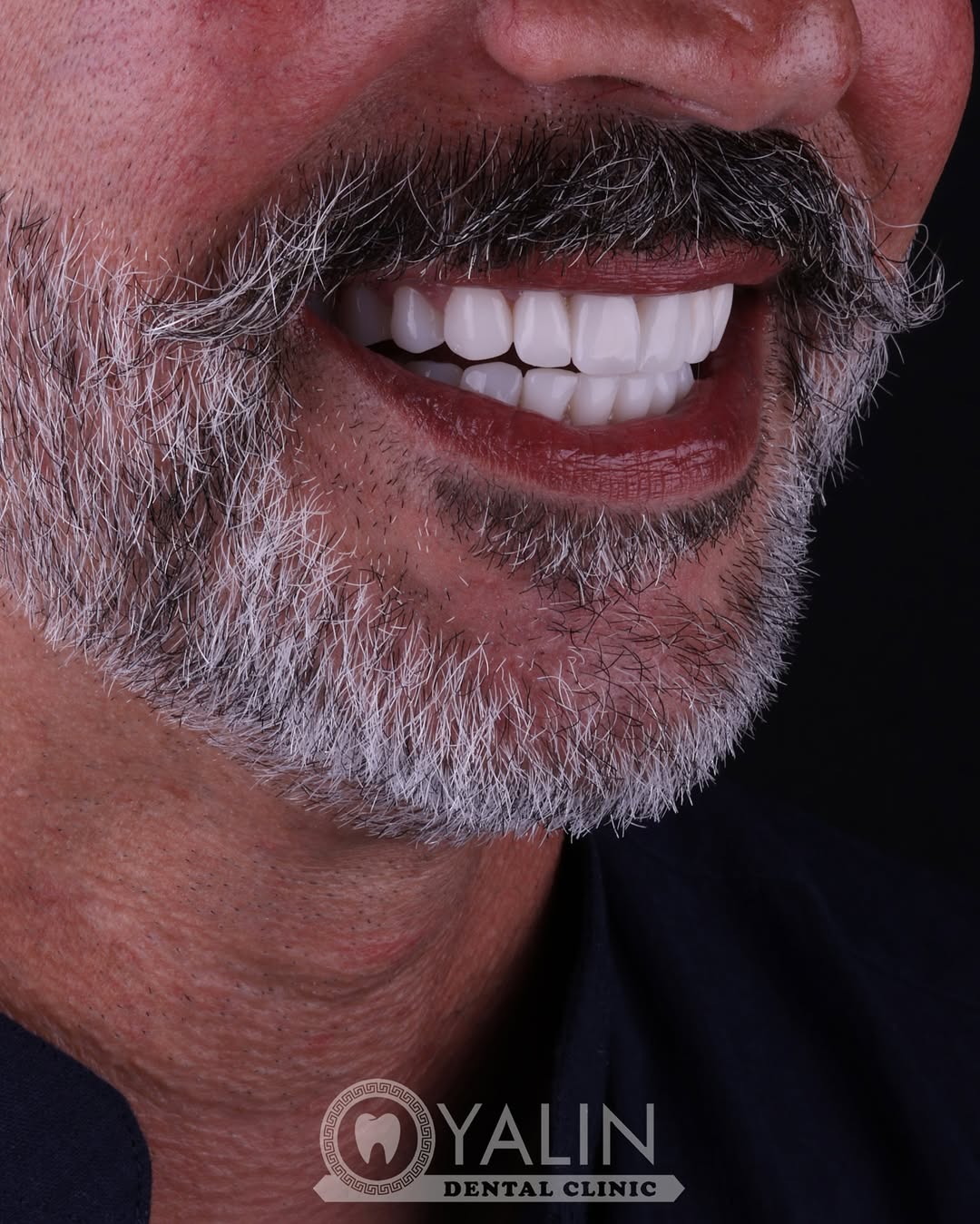 turkey-teeth-veneers before and after-7 