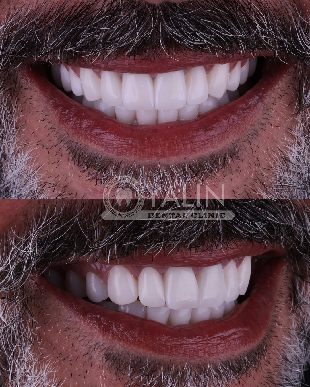 turkey-teeth-veneers before and after-8 