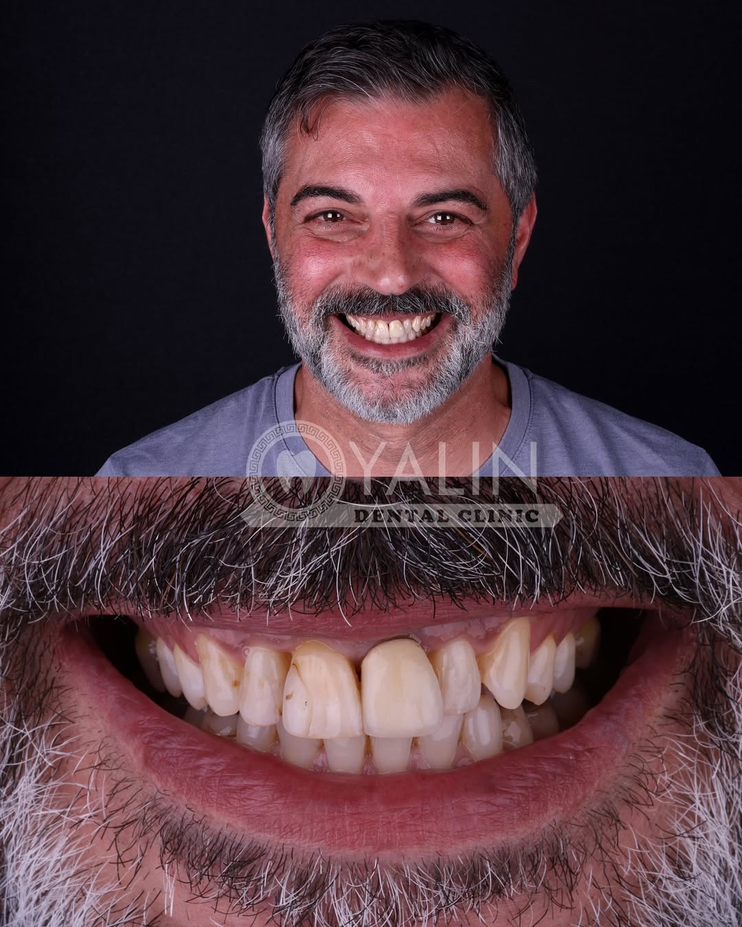 turkey-teeth-veneers before and after-9 