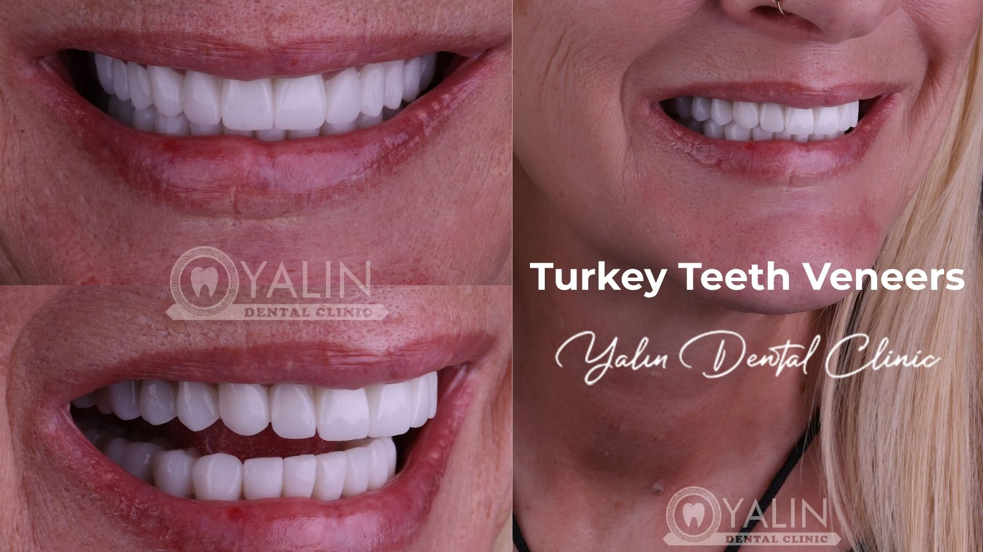 turkey-teeth-veneers-antalya