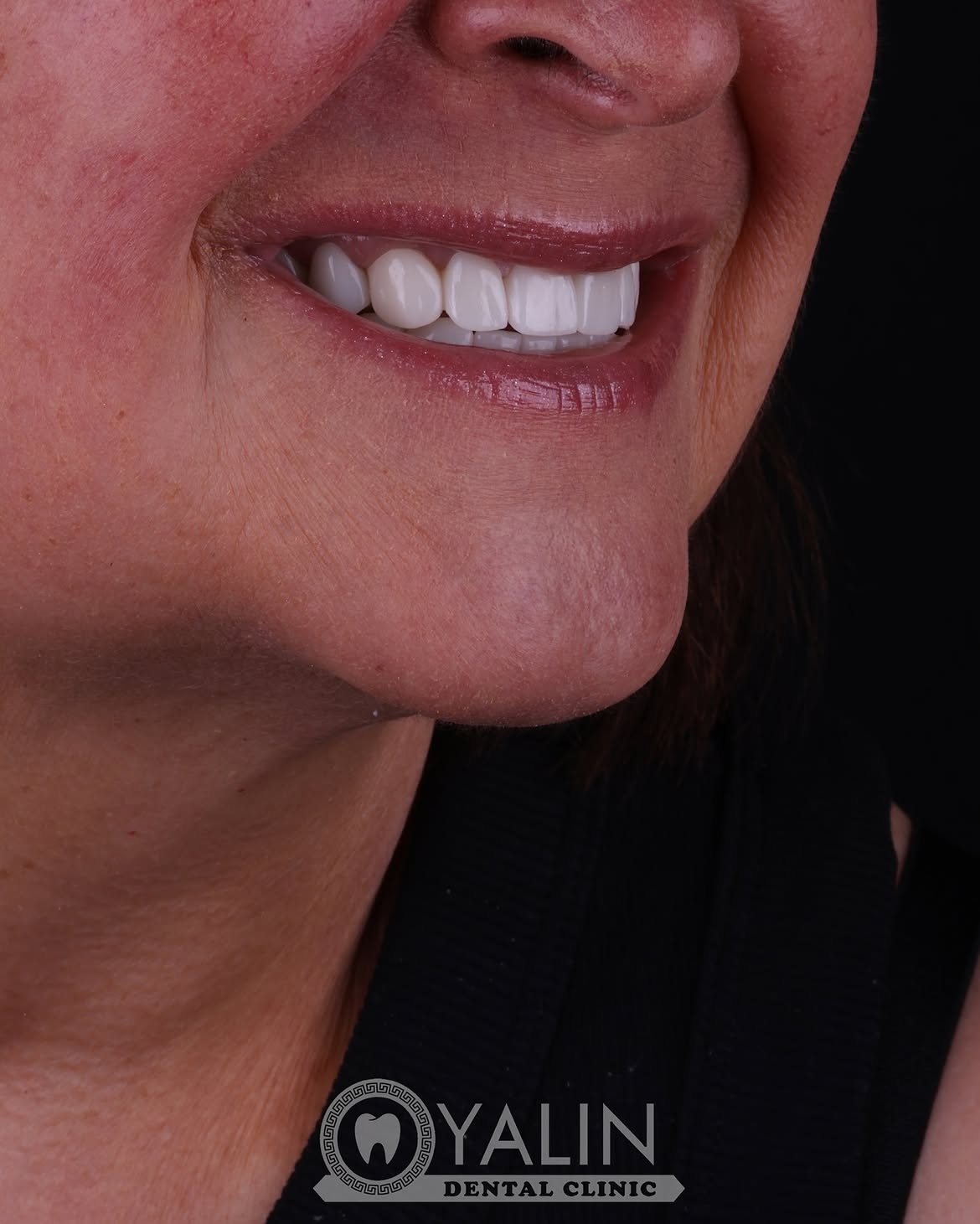 Dental Crown Before and After in Turkey, Antalya 12