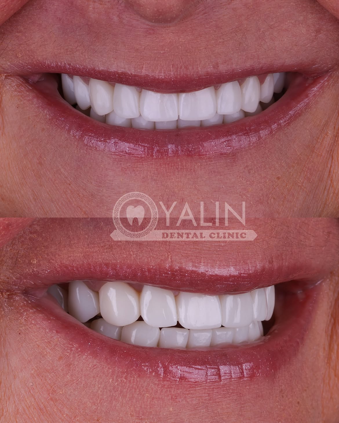 Dental Crown Before and After in Turkey, Antalya 13
