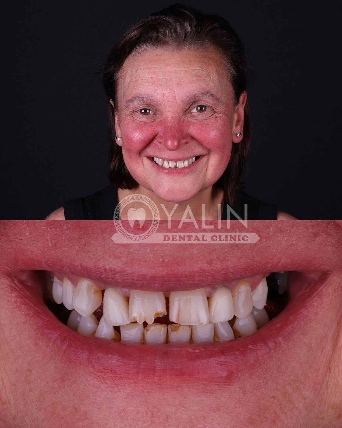 Dental Crown Before and After in Turkey, Antalya 14