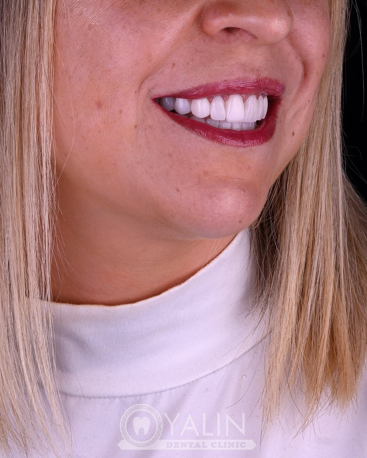 Dental Crown Before and After in Turkey, Antalya 2