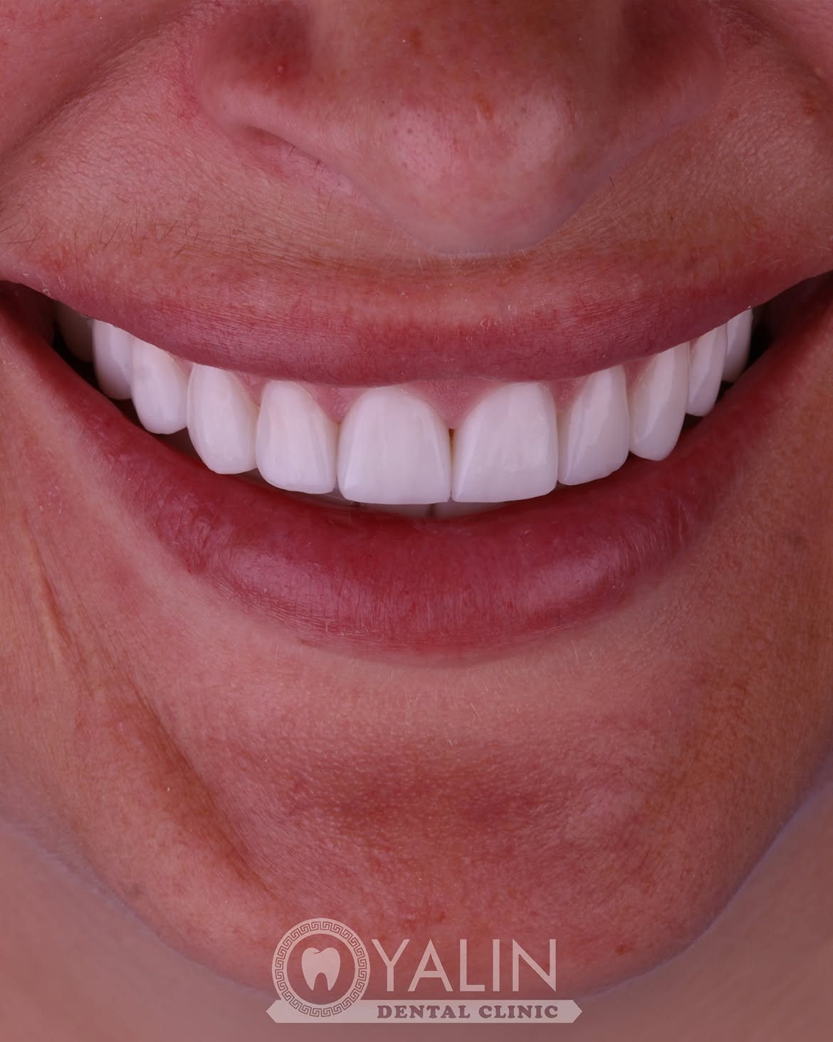 Dental Crown Before and After in Turkey, Antalya 7