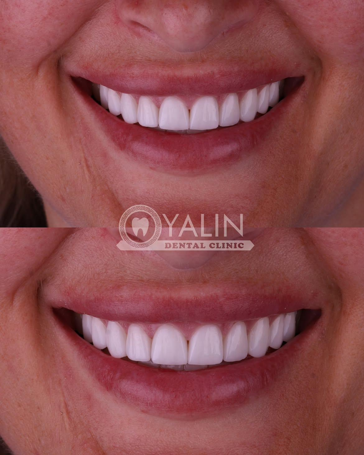 Dental Crown Before and After in Turkey, Antalya 8