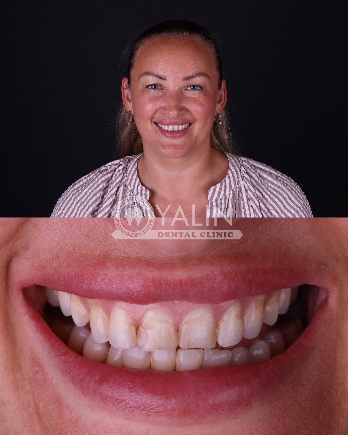 Dental Crown Before and After in Turkey, Antalya 9