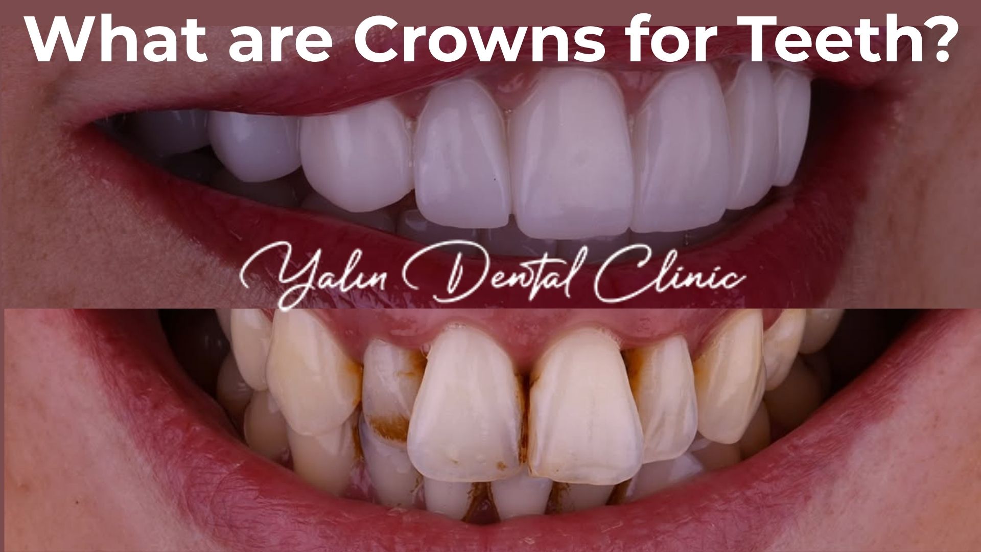 What are Crowns for Teeth in Turkey, Antalya? 