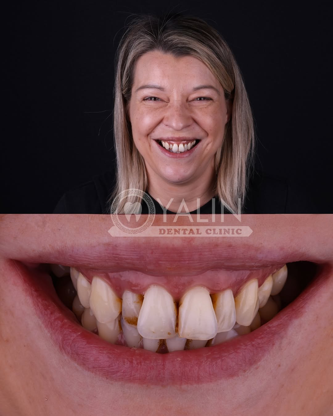 zirconia crown before and after-1 