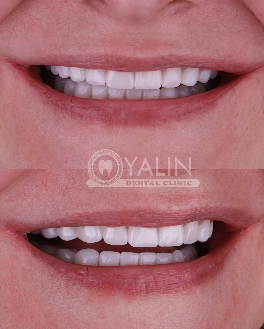 zirconia crown before and after-10 