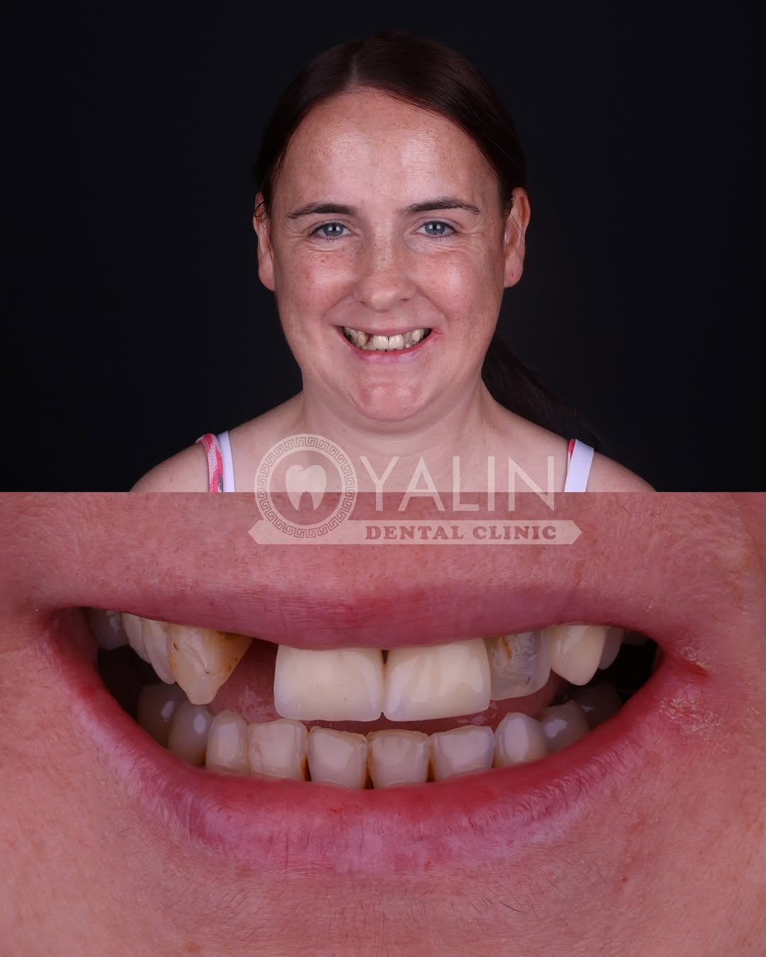 zirconia crown before and after-11 