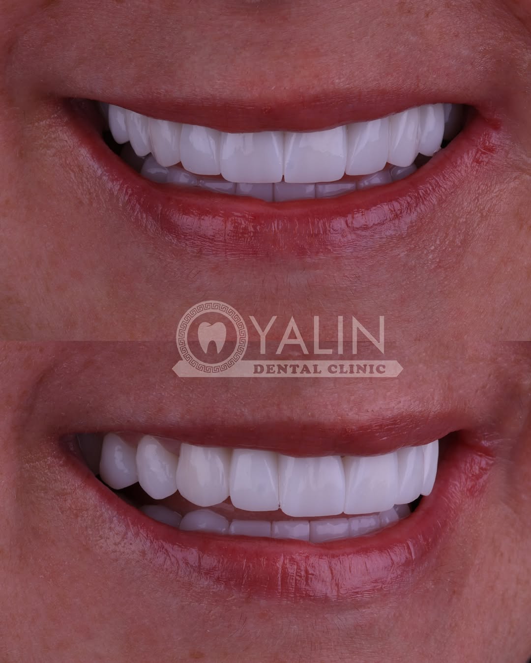 zirconia crown before and after-12 