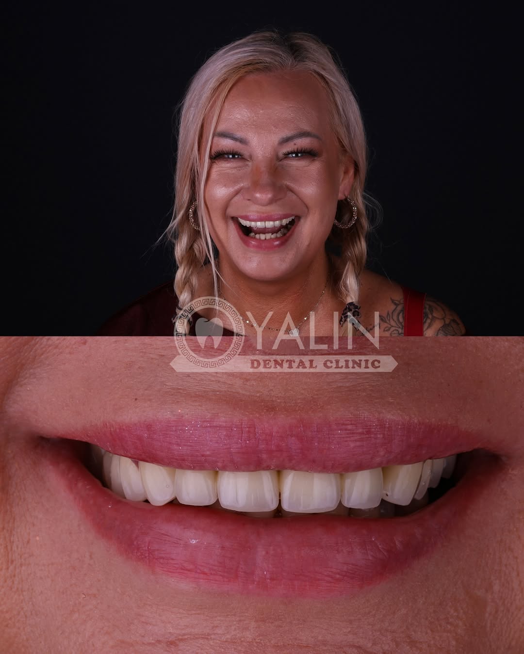 zirconia crown before and after-13 