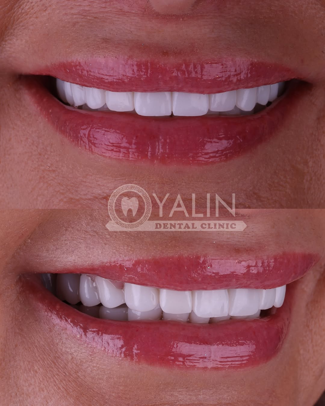 zirconia crown before and after-14 
