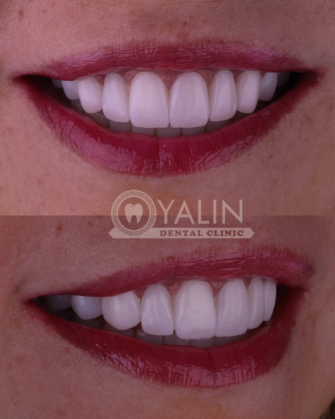 zirconia crown before and after-2 