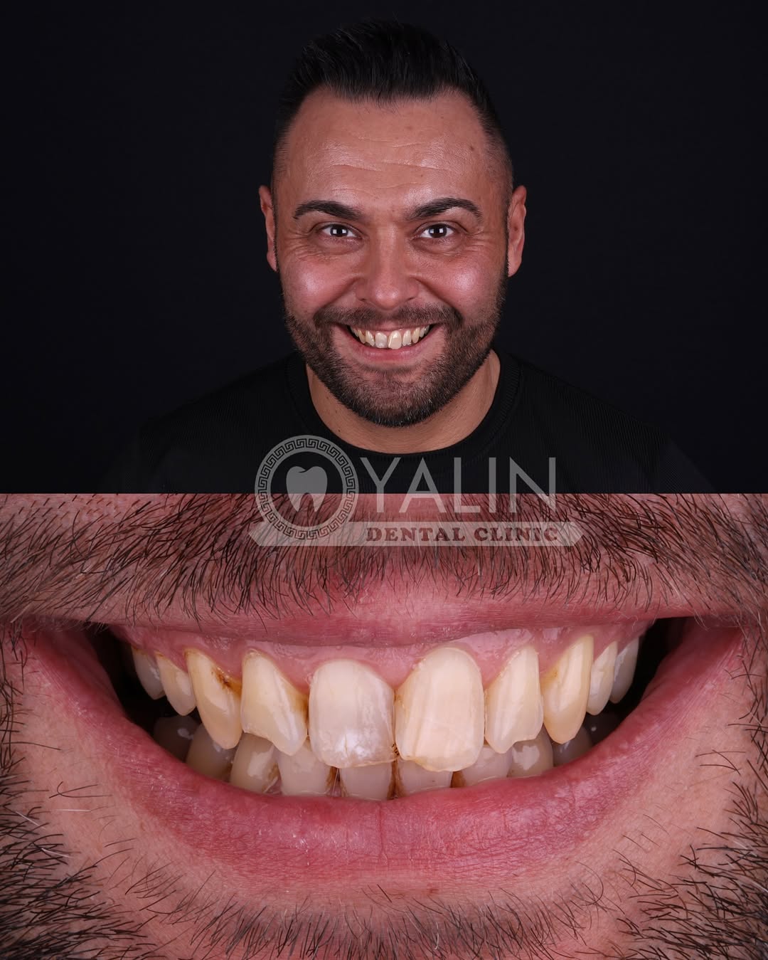 zirconia crown before and after-3 