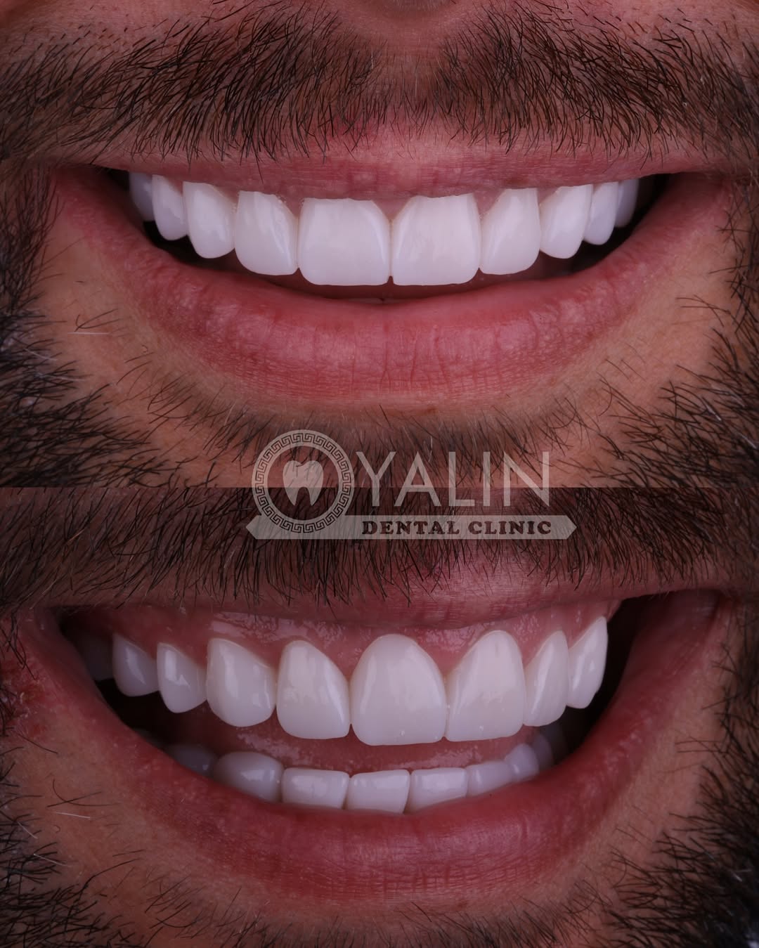 zirconia crown before and after-4 