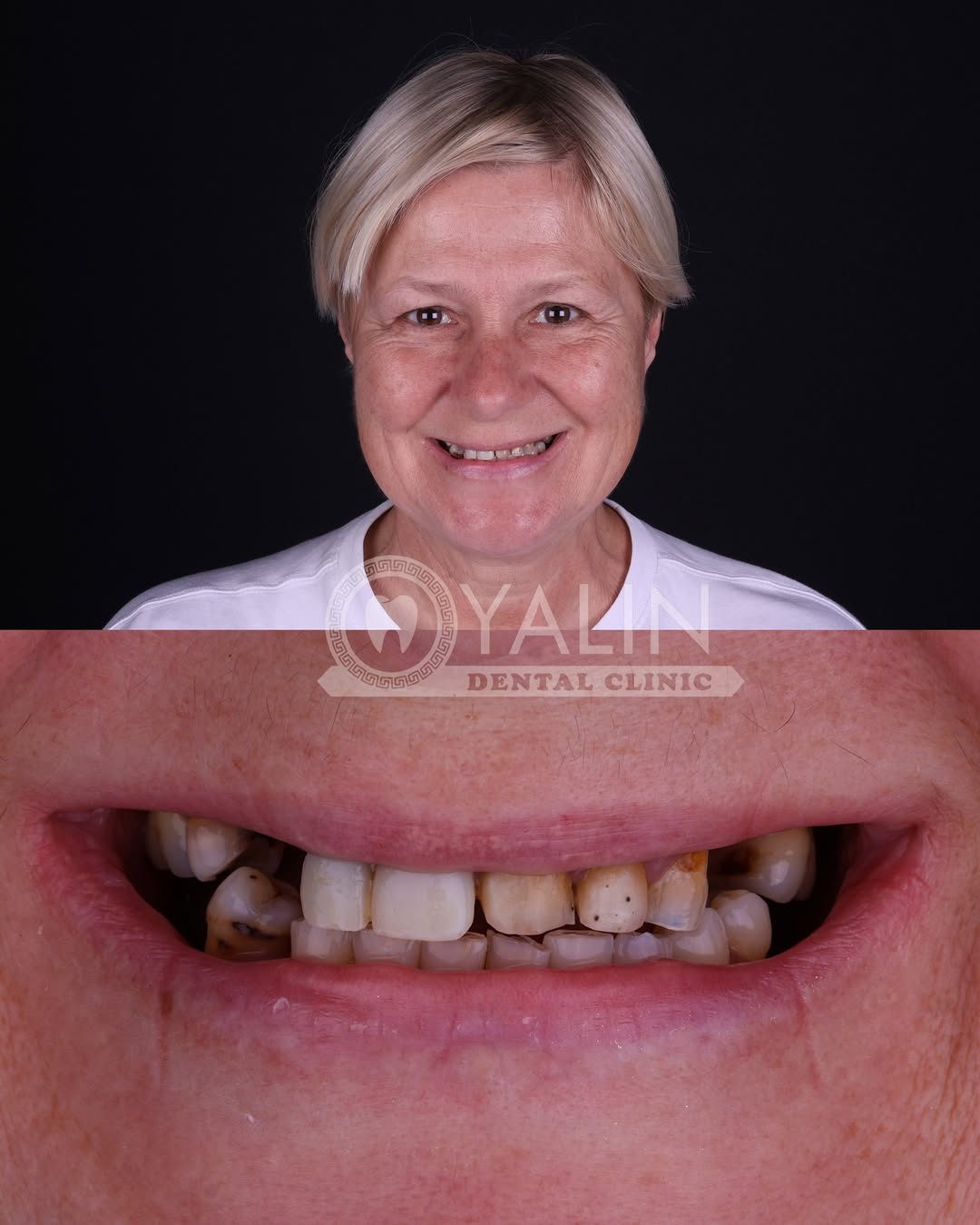 zirconia crown before and after-5 