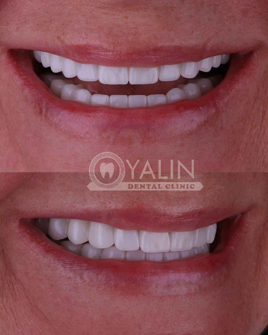 zirconia crown before and after-6 