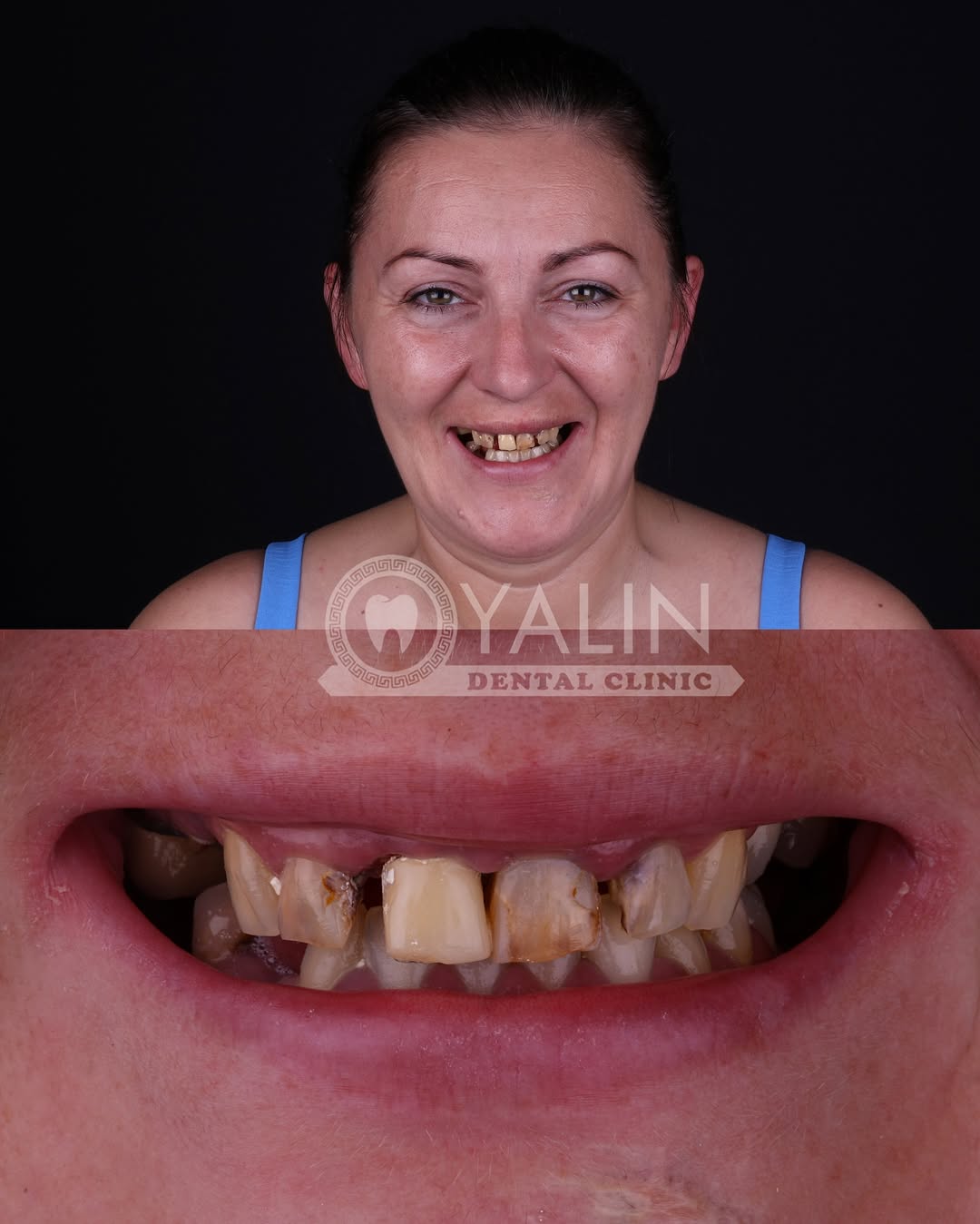 zirconia crown before and after-7 