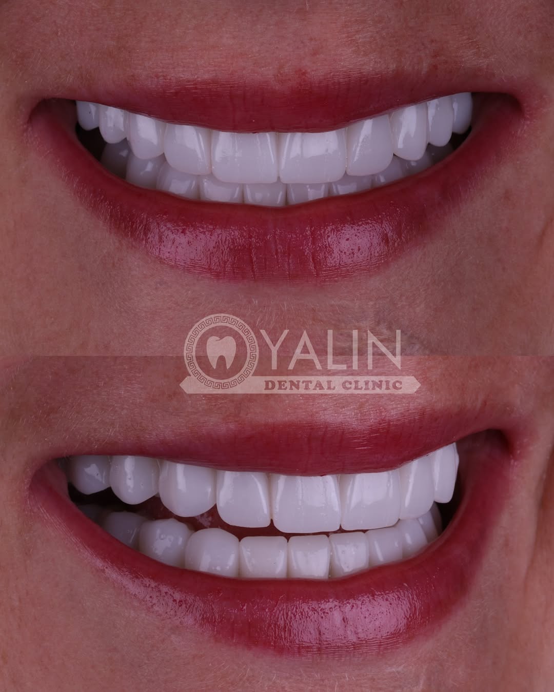 zirconia crown before and after-8 