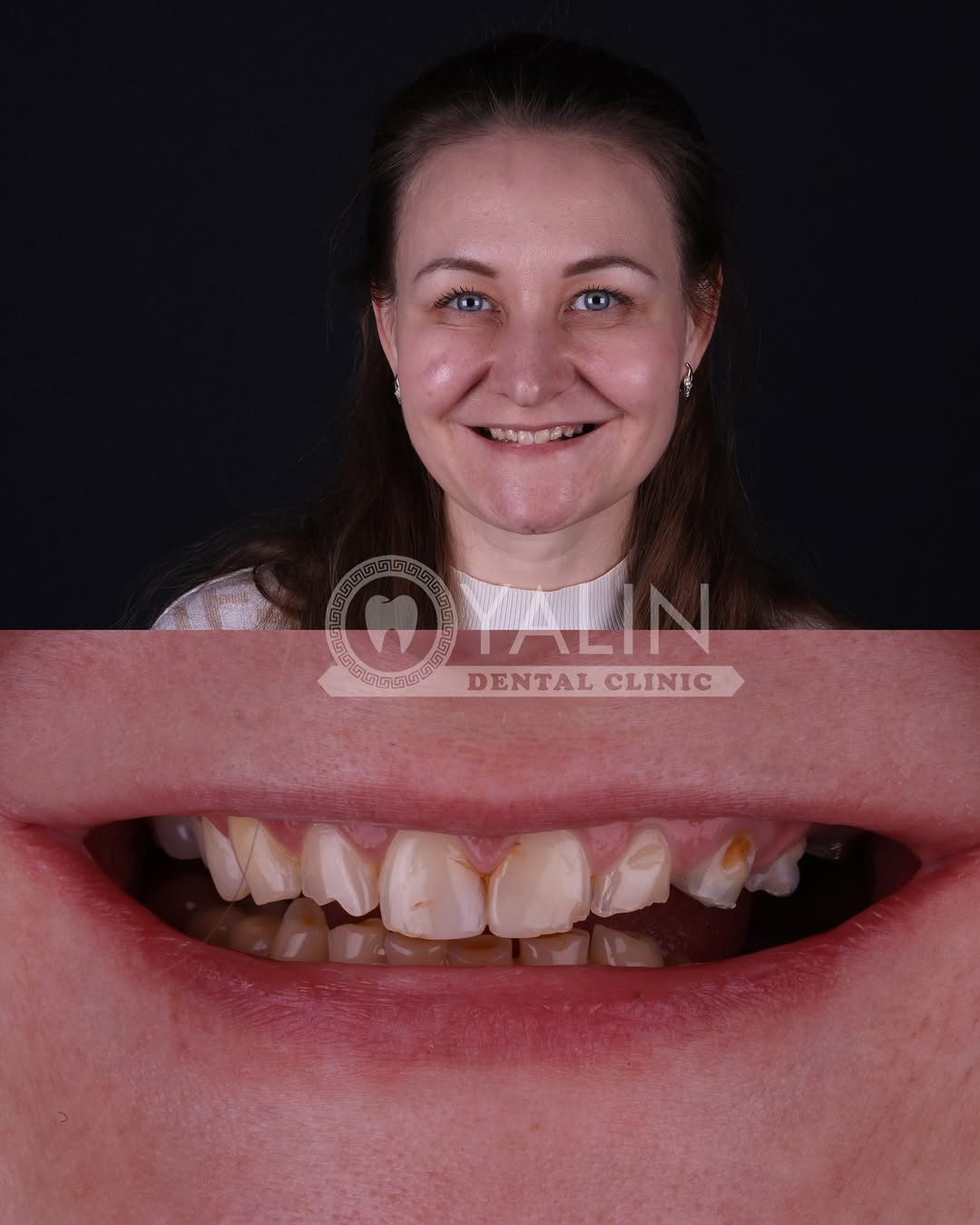 zirconia crown before and after-9 