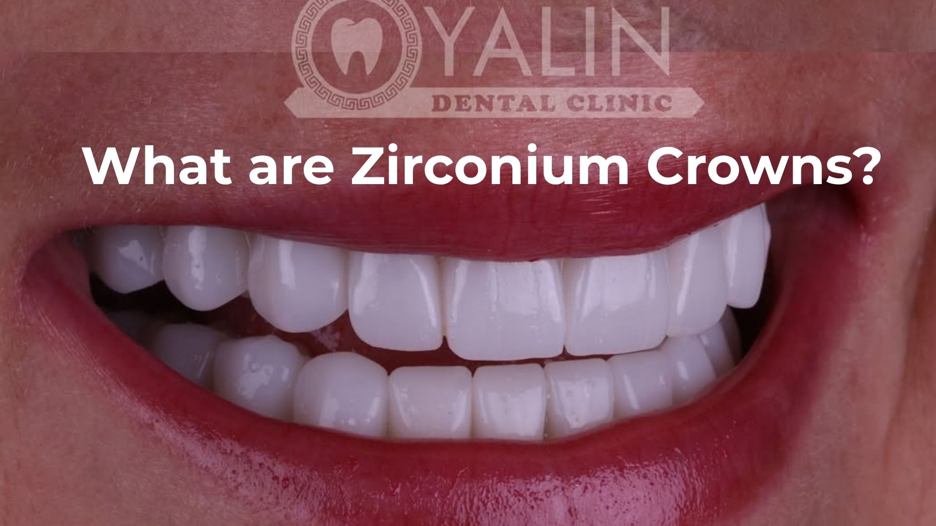 What are Zirconium Crowns?