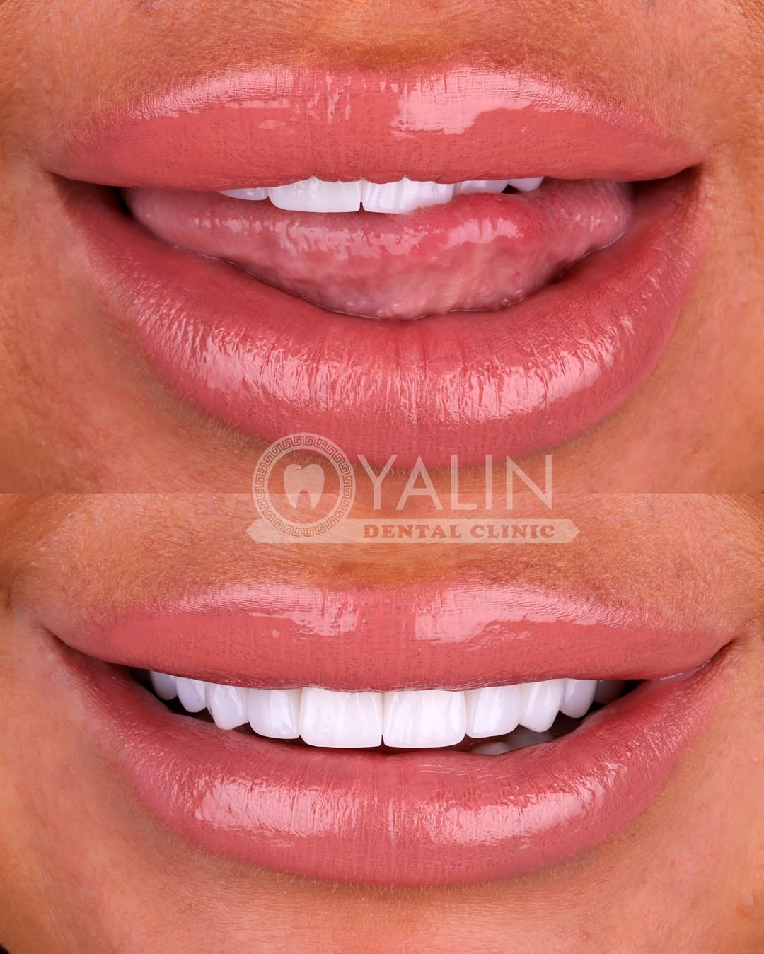 Yalındental Clinic, what-is-a-smile-makeover-1