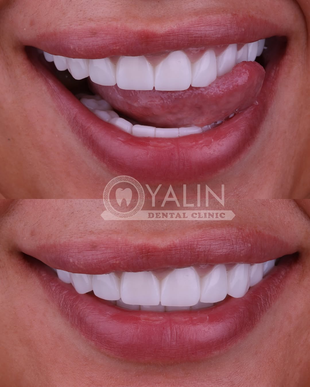 Yalındental Clinic, what-is-a-smile-makeover-2