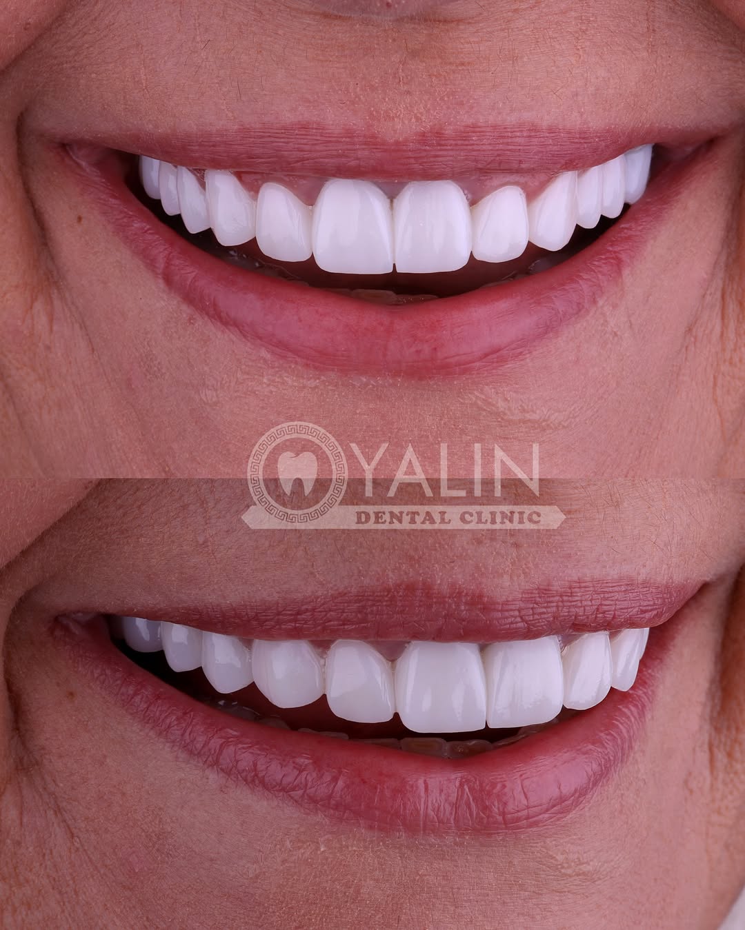 Yalındental Clinic, what-is-a-smile-makeover-3
