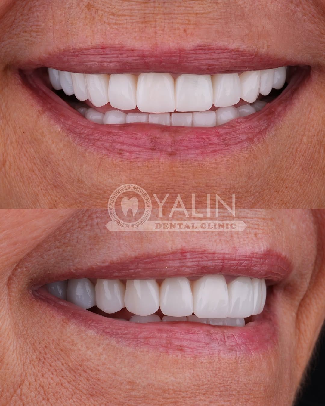 Yalındental Clinic, what-is-a-smile-makeover-4