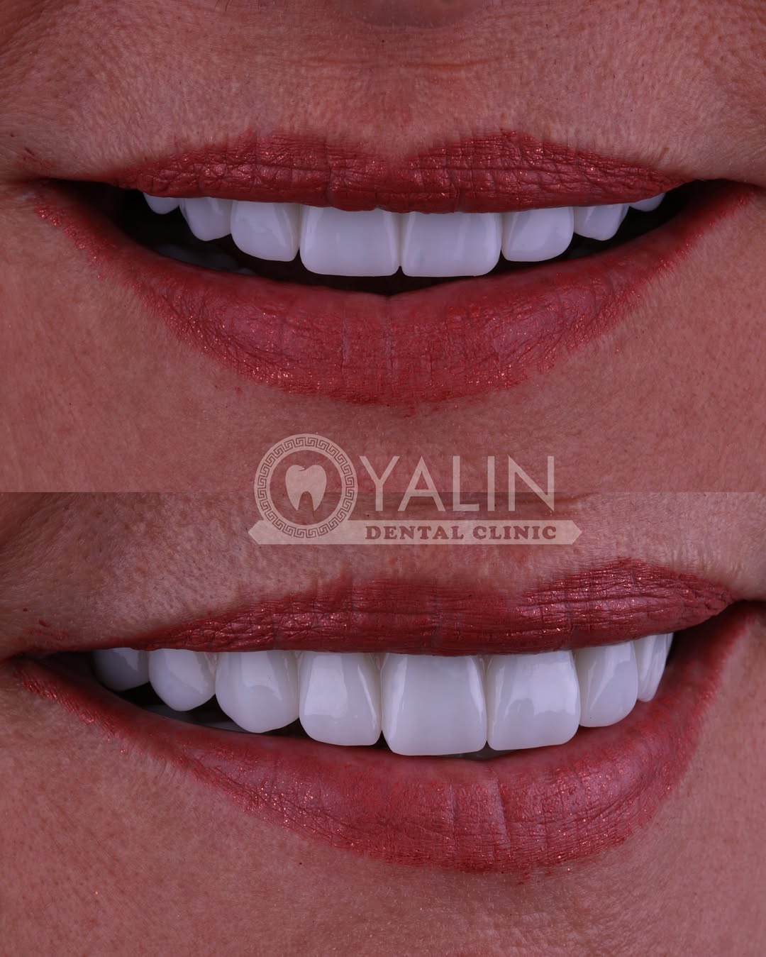 Yalındental Clinic, what-is-a-smile-makeover-5