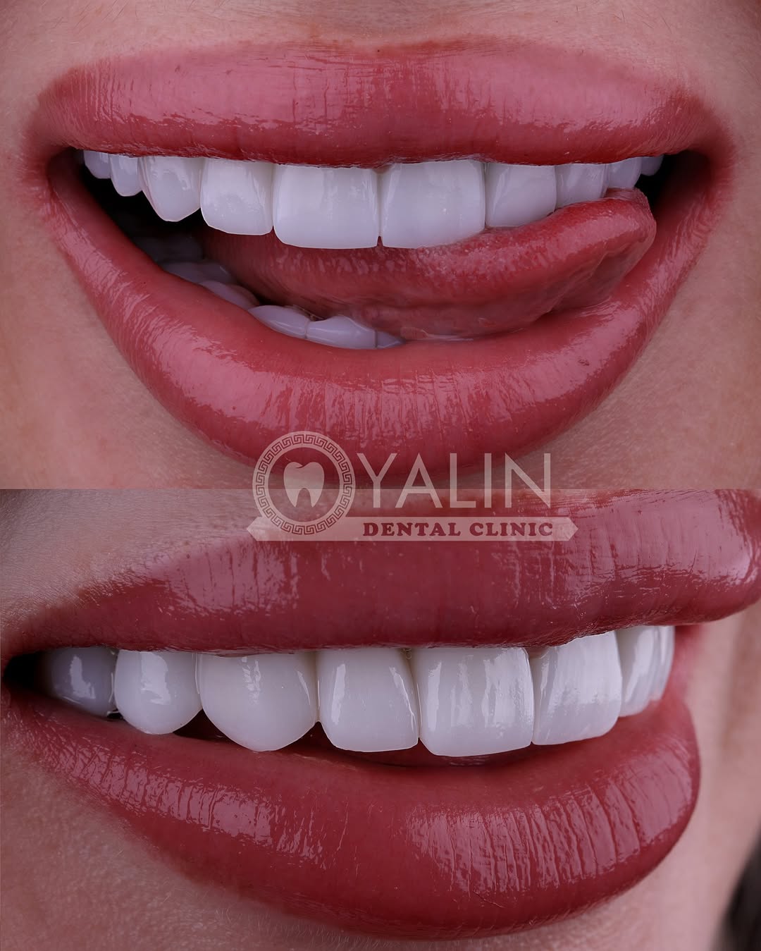 Yalındental Clinic, what-is-a-smile-makeover-6