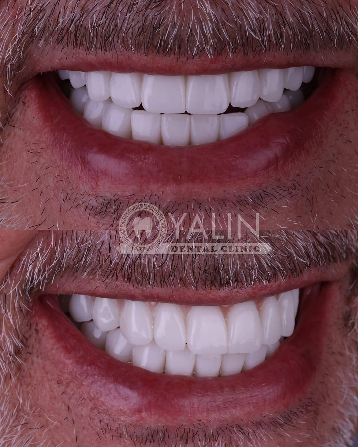 all-on-4 before and after-10 