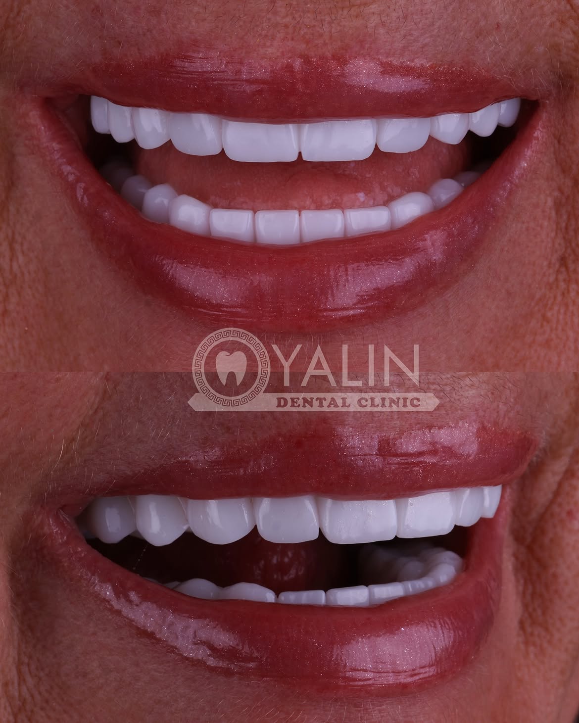all-on-4 before and after-2 