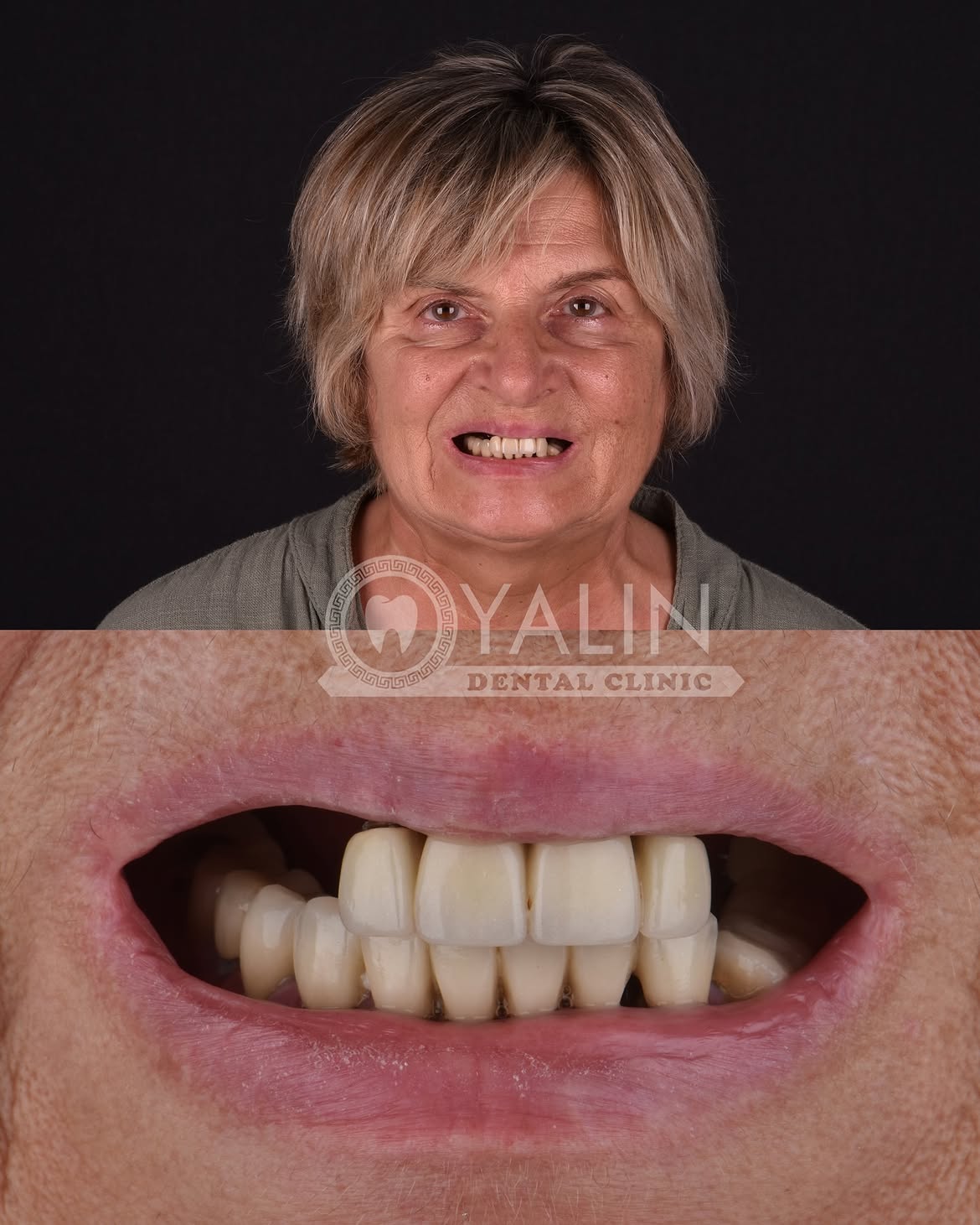 all-on-4 before and after-3 