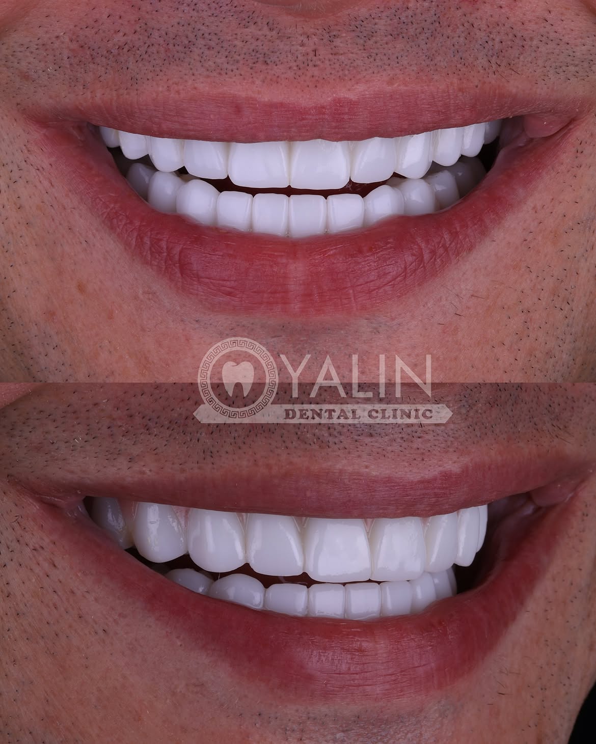 all-on-4 before and after-6 