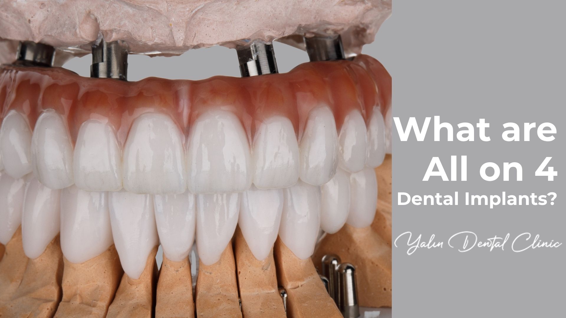 What are All on 4 Dental Implants?
