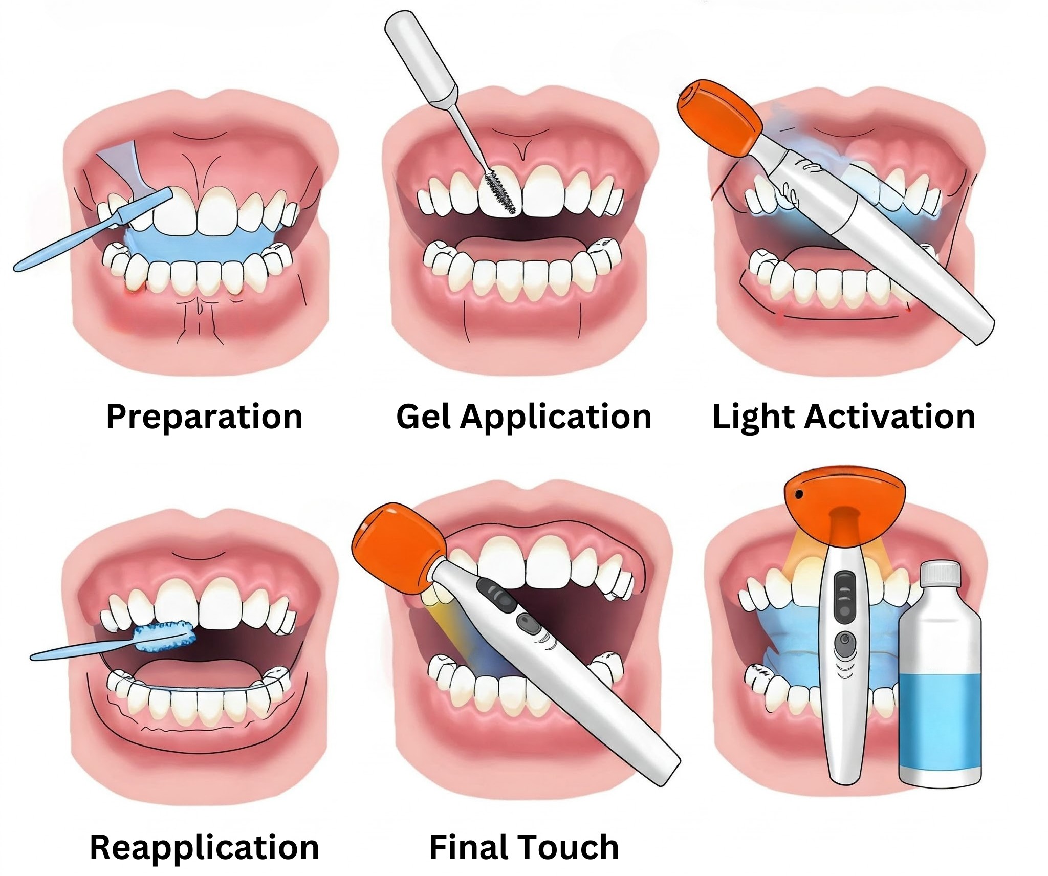 Zoom Teeth Whitening