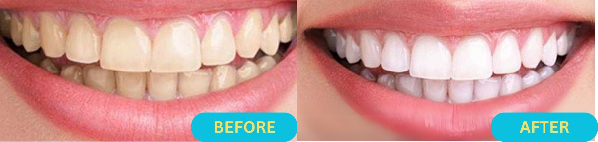 Zoom Teeth Whitening Before and After-1