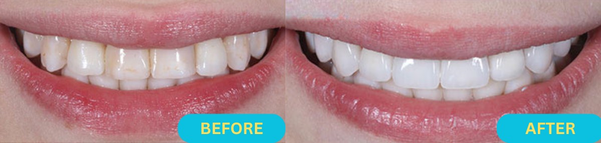 Zoom Teeth Whitening Before and After